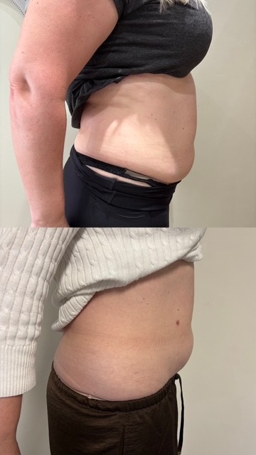 Fat Dissolving Treatments 035e8964 b8d4 42b5 9dcd ab189881b148