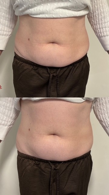 Fat Dissolving Treatments 11e113af 2408 4538 845b d6f37b224318