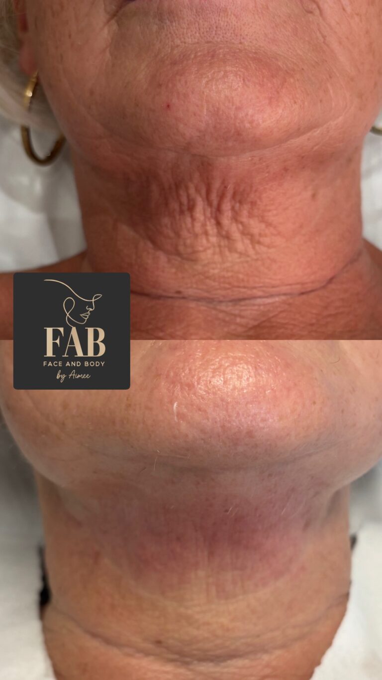 Skin Boosters 535ecb75 a4d0 4181 9d7f 1a4b000d6e26