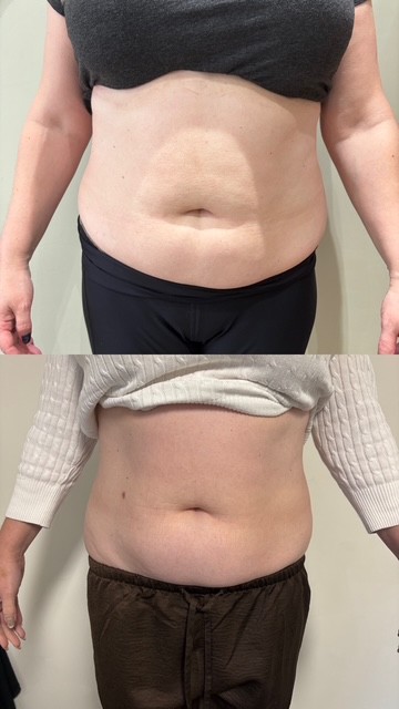 Fat Dissolving Treatments 59bb1d2e a5f0 4fd1 bf68 e9b50cc786a7
