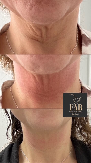 Skin Boosters 6b867c46 dc8b 42b6 93ea 8c98f0b68259