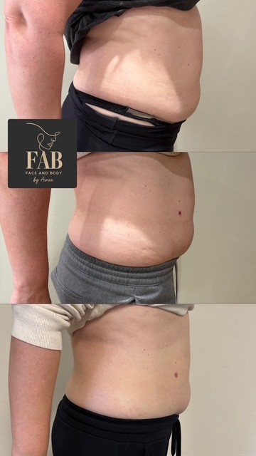 Fat Dissolving Treatments 7135ae2f a0e0 43da 81da fbe34daa6f1d