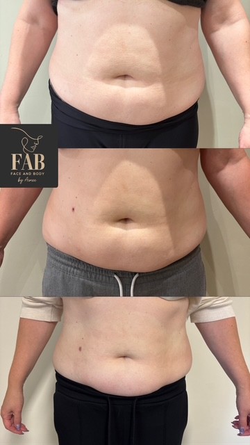 Fat Dissolving Treatments 89d2b717 8a7d 4b3f b883 3fe18bf3daf2