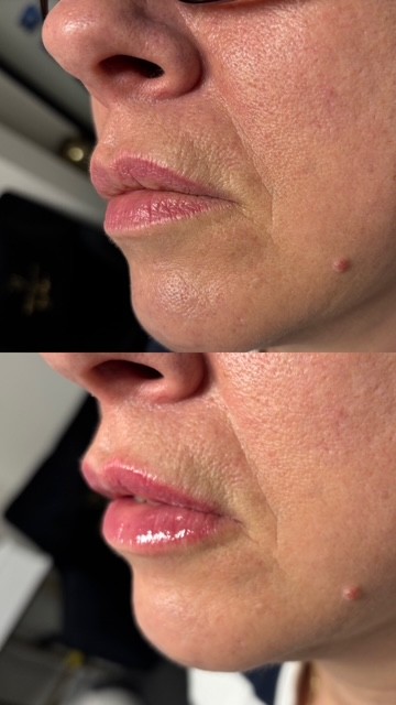 Skin Boosters 8d78d024 8962 43eb ad25 639c35b828b4