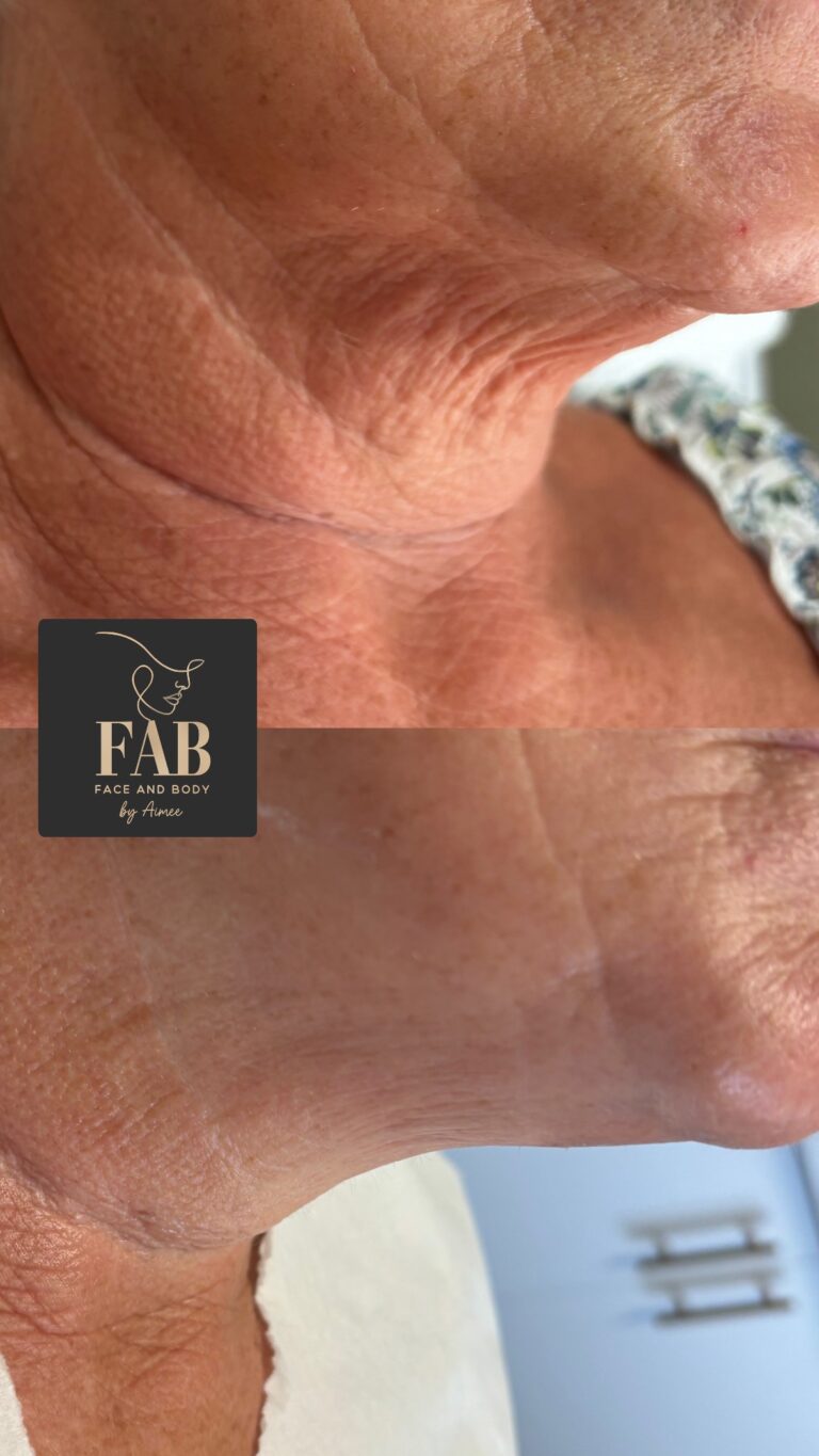 Skin Boosters 9d531070 1b27 4d03 83c5 15567d1a9ead