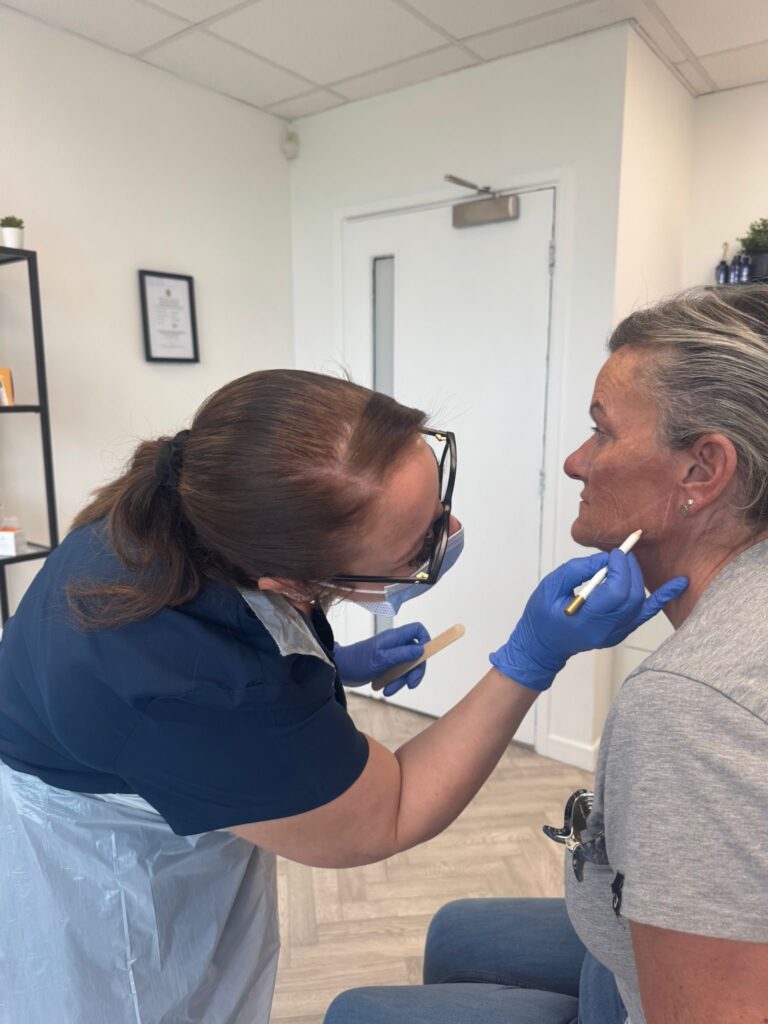 Dermal Filler jaw filler mark up