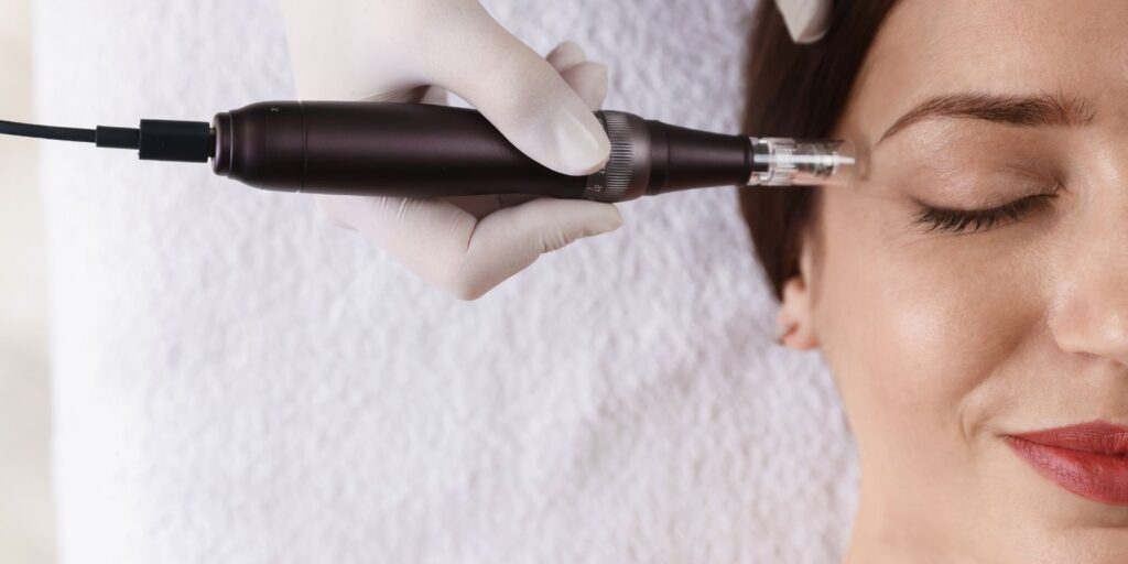 microneedling