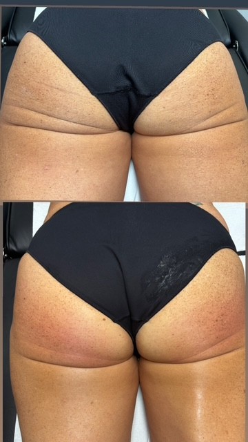 Fat Dissolving Treatments cavitation (2)