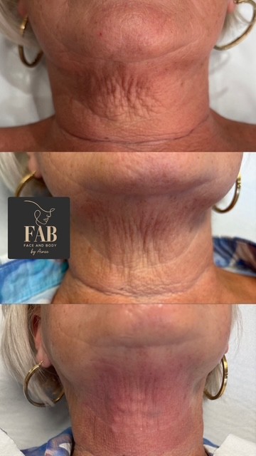 Skin Boosters cdc189ea c7f8 460e a727 298195092137