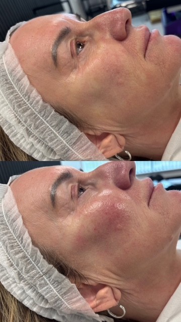 Dermal Filler cheek filler (2)