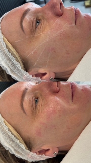 Dermal Filler cheek filler (3)