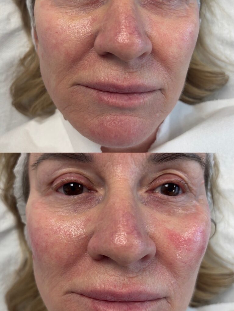 Dermal Filler cheek filler (4)