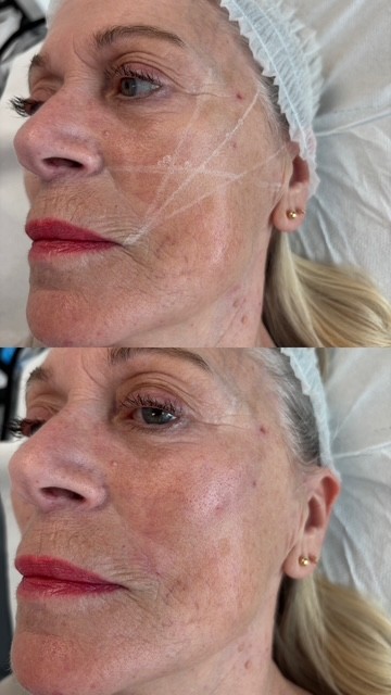 Dermal Filler cheek filler (5)