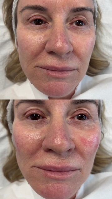Dermal Filler cheek filler (6)