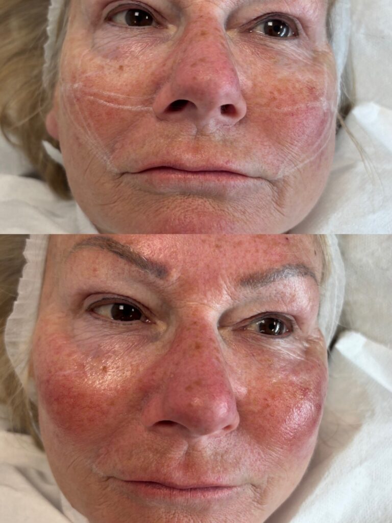 Dermal Filler cheek filler (8)