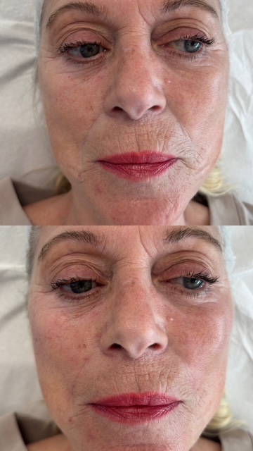 Dermal Filler cheek filler