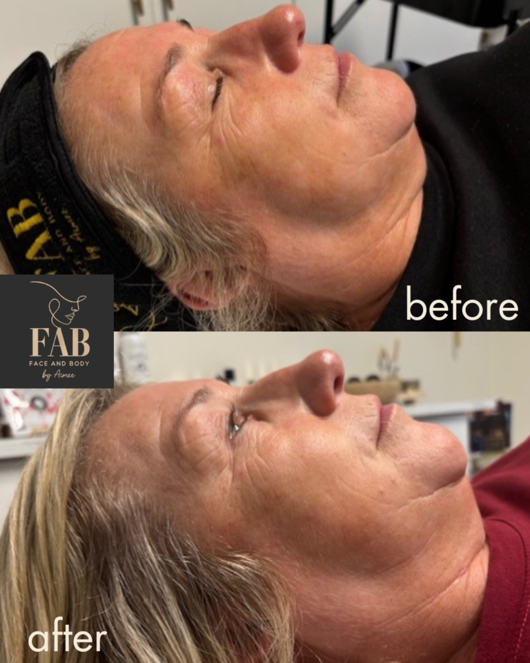 chemical peel