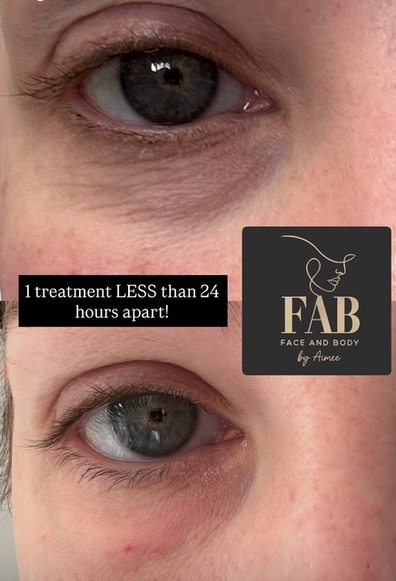 Skin Boosters dcf094c8 6349 420b aa04 1203ebc78be7