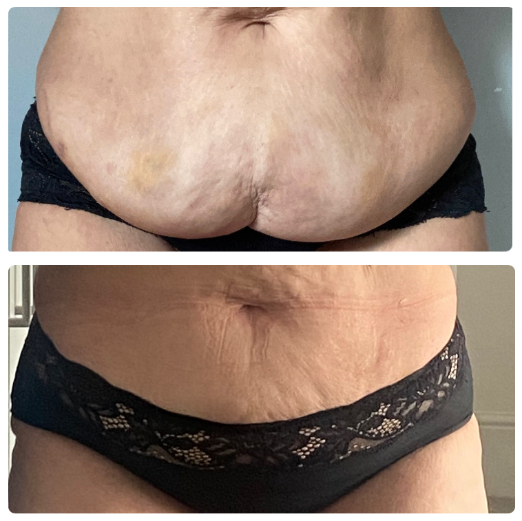 Fat Dissolving Treatments fat dissolving