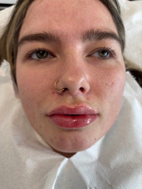 Dermal Filler lip filler (2)