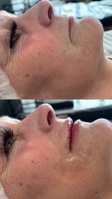 Dermal Filler lip filler (3)