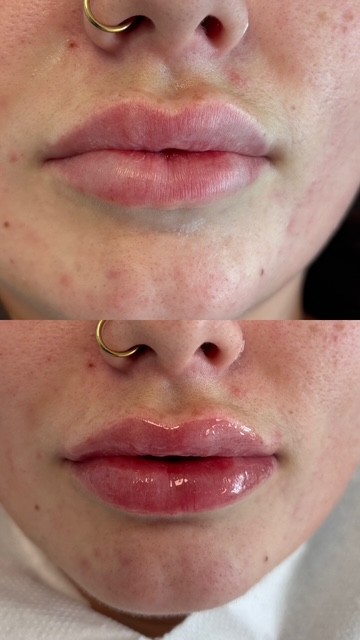 Dermal Filler lip filler (4)