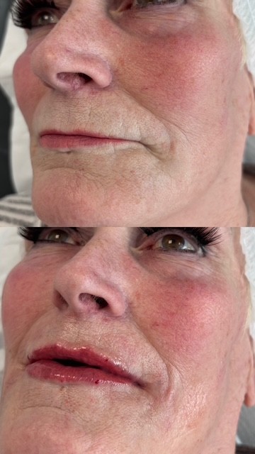 Dermal Filler lip filler (5)
