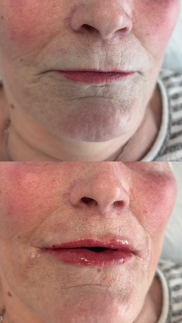 Dermal Filler lip filler
