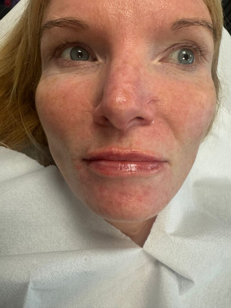 Dermal Filler lips after