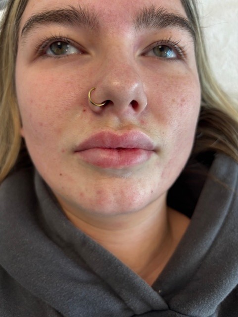 Dermal Filler lips before (2)
