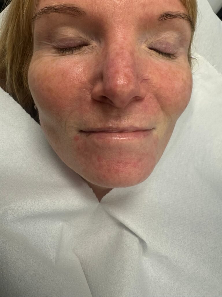 Dermal Filler lips before