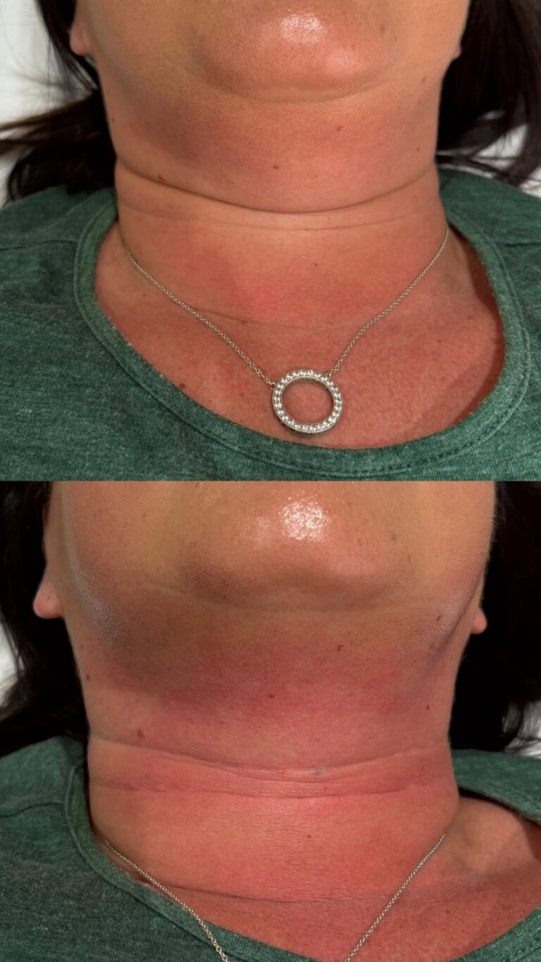 mesotherapy