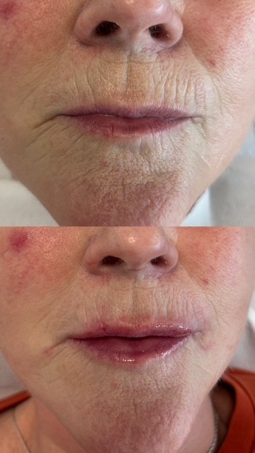 Dermal Filler perio oral and lips